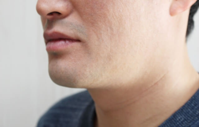 22992a9dbd990f11e8e06968367b0be4 s - ヒゲ脱毛直後、肌が赤くなるのは平気なの? 22992a9dbd990f11e8e06968367b0be4 s - ヒゲ脱毛直後、肌が赤くなるのは平気なの?