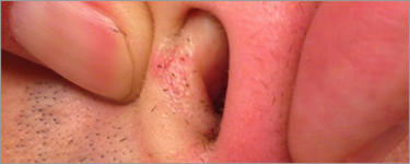 1 7 - 鼻毛脱毛って本当に大丈夫なの？鼻毛脱毛のメリットとデメリットをご紹介