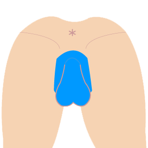 L vio i - VIO脱毛 3部位セット