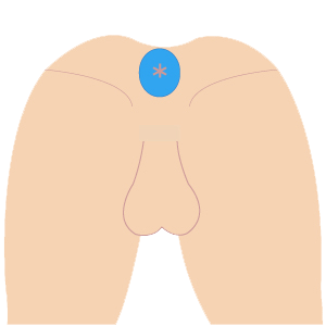 L vio o - VIO脱毛 3部位セット