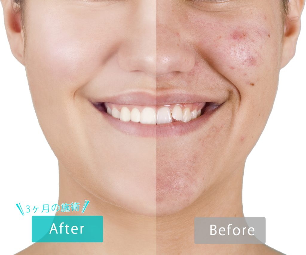 ニキビ1 1024x854 - ニキビ対策の光エステ