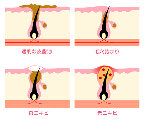 ニキビ2 - ニキビ対策の光エステ