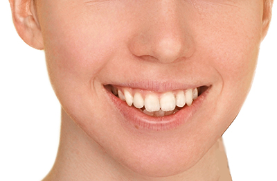 ニキビ3 - ニキビ対策の光エステ