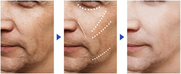 光フェイシャル - 40代以上男性にも好評！「男のエステ」新メニュー！