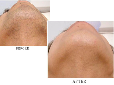 効果 - 脱毛機レンタル