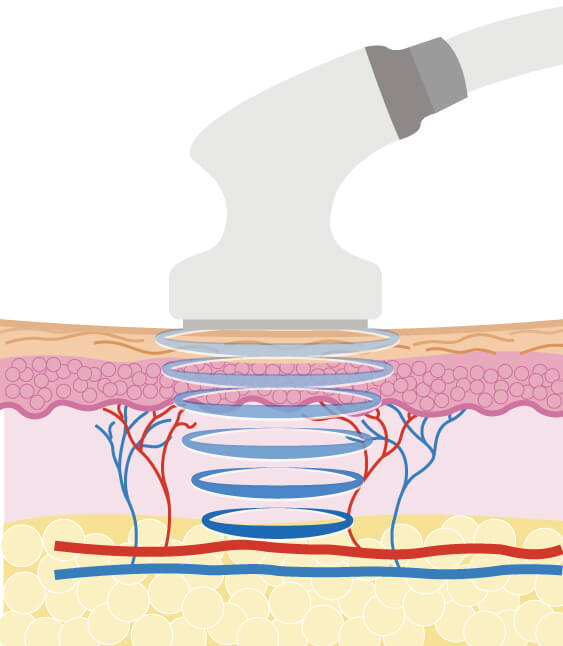 キャビテーション - セルフメンズエステ【プロのエステマシン】