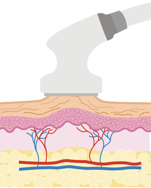 サイクロン吸引 - セルフメンズエステ【プロのエステマシン】