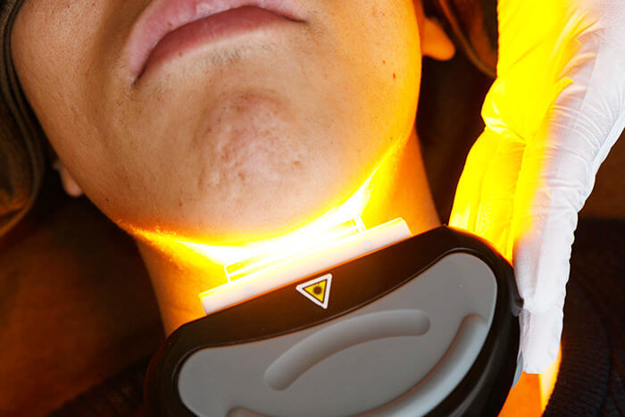 ひげ脱毛 - フリー・全身脱毛プラン