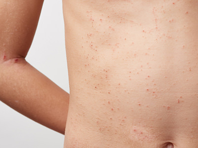 アトピー2 - アトピー肌・敏感肌でも脱毛はできる！最適なメンズ脱毛方法をズバリ教えます