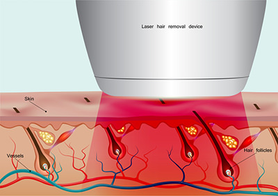 レーザー脱毛 - あなたにぴったりな脱毛方法をチェック！仕組みを知ることで脱毛が分かる