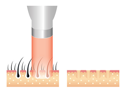 光脱毛 - あなたにぴったりな脱毛方法をチェック！仕組みを知ることで脱毛が分かる