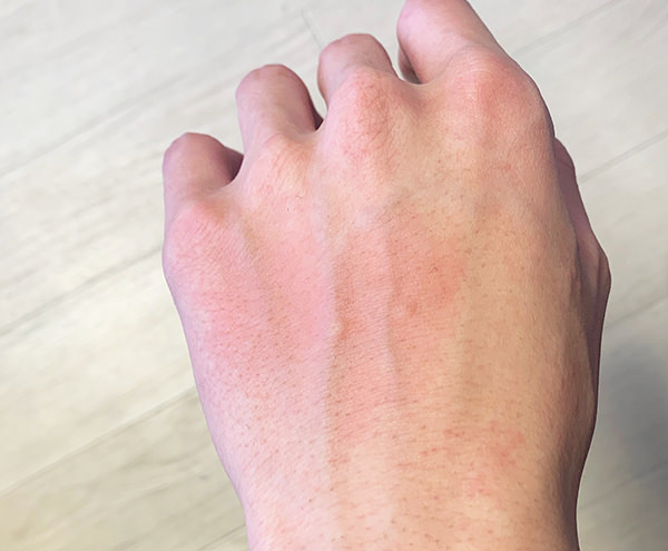 赤み - メンズ脱毛後の赤みの原因は？赤みを抑えるためのセルフケア5つ