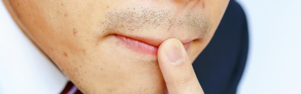 14 0 - ヒゲ脱毛の安いサロンを探す前に！どろぼうヒゲとおすすめの対策 | メンズ脱毛NAX