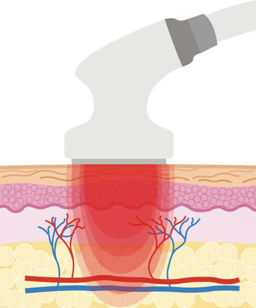 RF - SELF IMPROVE料金【加古川店】