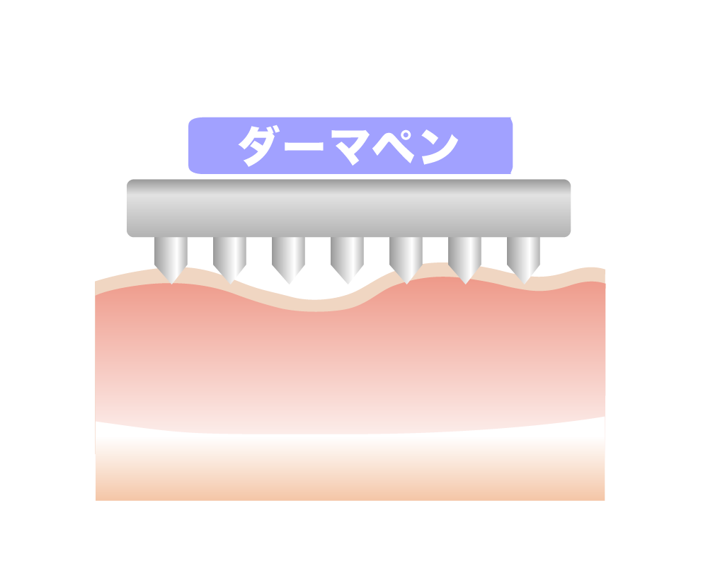 ダーマペンダーマ - SELF IMPROVE料金【加古川店】