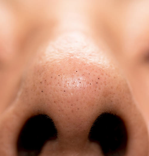 小鼻脱毛 - 『小鼻脱毛』五反田で鼻の脱毛が可能な脱毛サロン！いちご鼻改善には脱毛？！